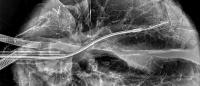 catheter inside lung